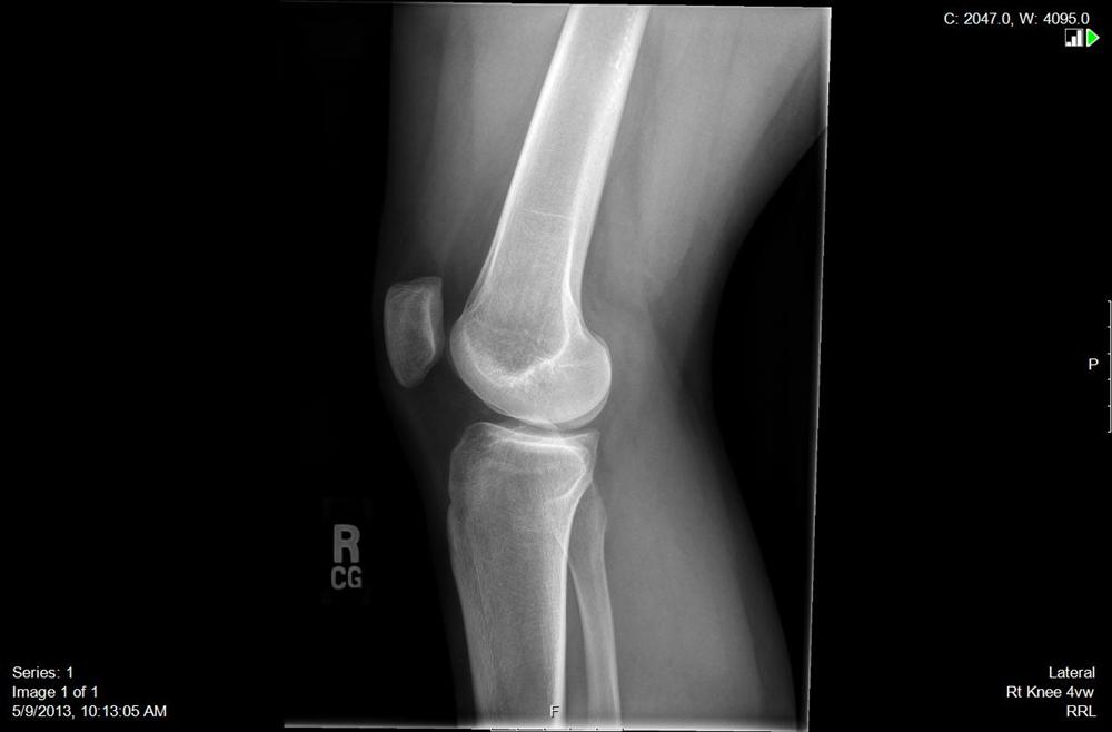 Idiopathic Chondromalacia Patellae Knee & Sports Orthobullets